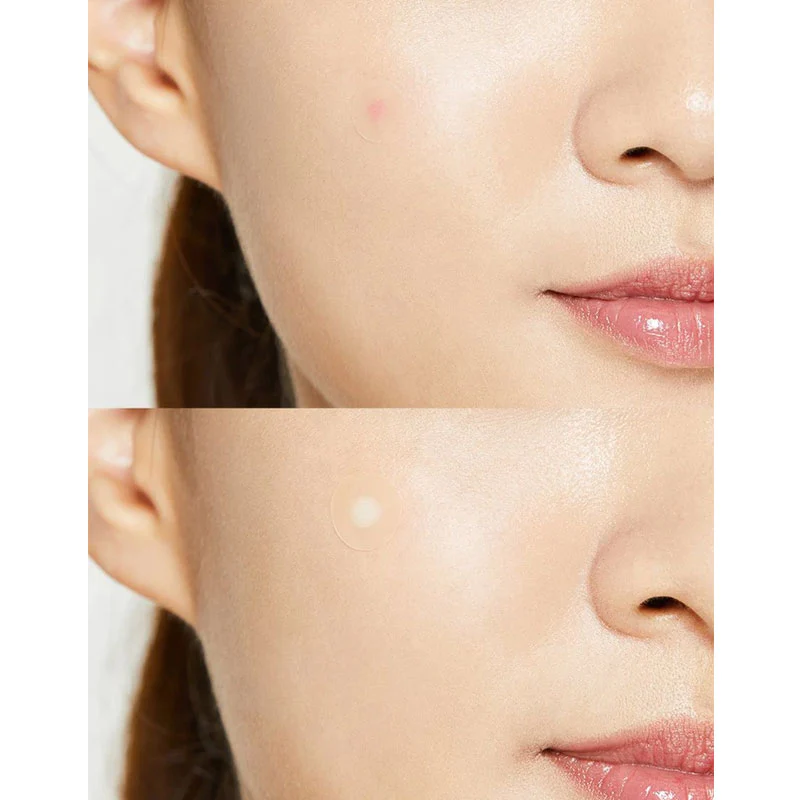 Acne Pimple Master Patch